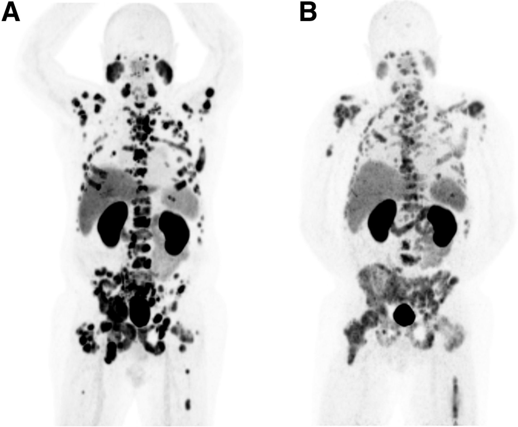 tratamiento_del_cancer_de_prostata_mediante_PETCT_con_PSMA